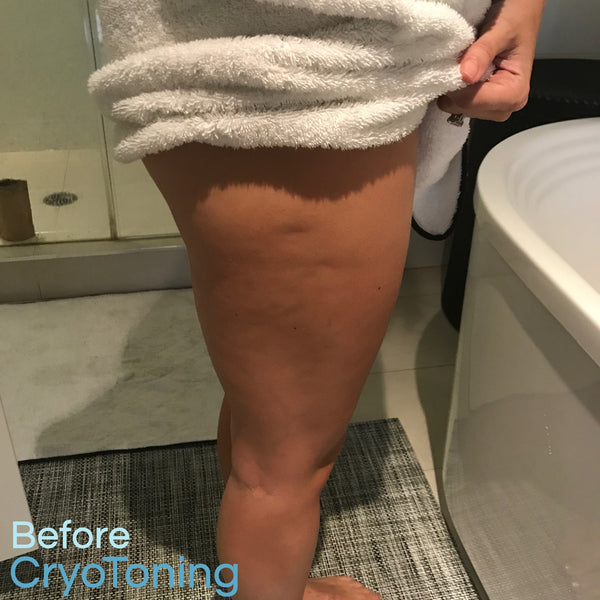 Cellulite Results, Before and After